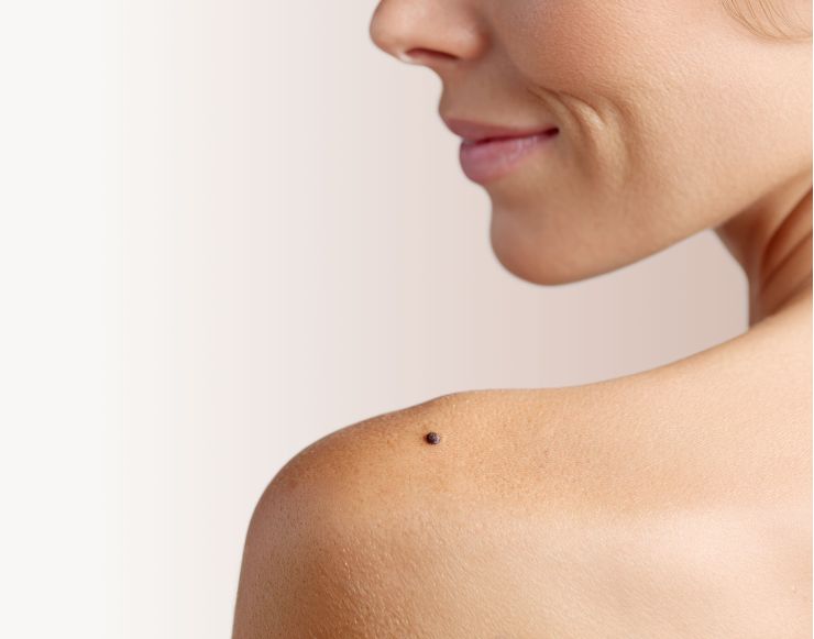 Ādas veidojumu noņemšana